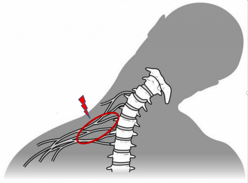 lesione traumatica dei plesso brachiale