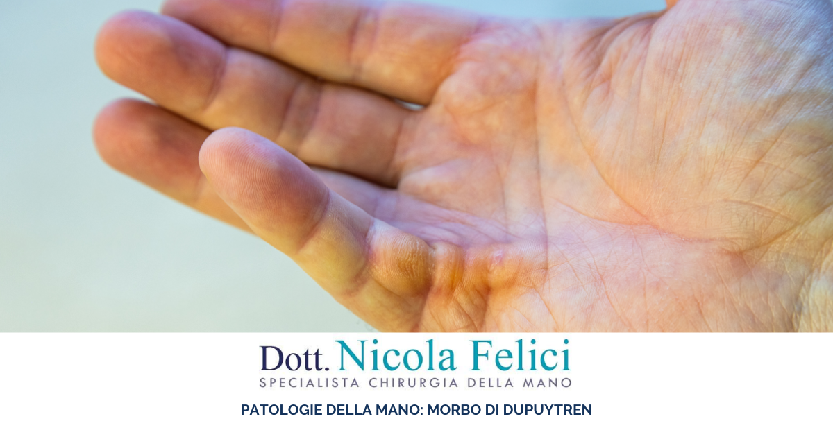 Morbo Dupuytren – Patologie della mano, Dottor Nicola Felici